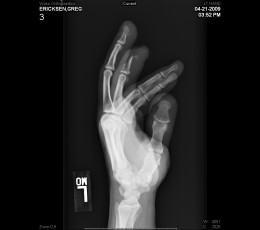 X-ray of the damage