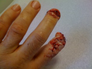 A view of the index finger a couple of days later
